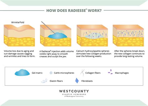queensland radiesse|How It Works .